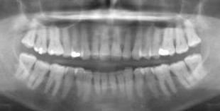 2D panoramic X-ray
