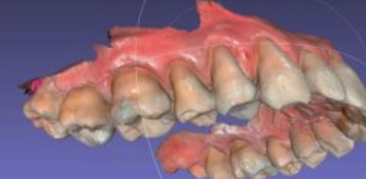 3D intraoral scan